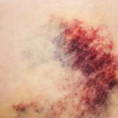 Siniak na skórze, z odcieniami czerwieni, fioletu i żółci. Wygląda jak ślad po uderzeniu, może nawet exacyl.