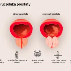 Porównanie zdrowej prostaty i gruczolaka prostaty. Obrazek ilustruje objawy przerostu prostaty, takie jak ból, częste parcie na mocz i słaby strumień.
