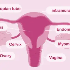 Schemat kobiecych narządów rozrodczych: jajniki, jajowody, macica z endometrium i mięśniówką, szyjka macicy i pochwa.