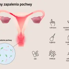 Ilustracja przedstawia przyczyny zapalenia pochwy: cukrzyca, mokra bielizna, irygacja, środki higieny intymnej, leki, infekcje, zaburzenia hormonalne.