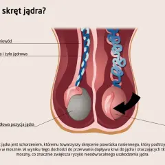 Ilustracja pokazuje prawidłową pozycję jądra i jego skręt. Skręt jądra to stan, gdy powrózek nasienny się skręca, blokując dopływ krwi.