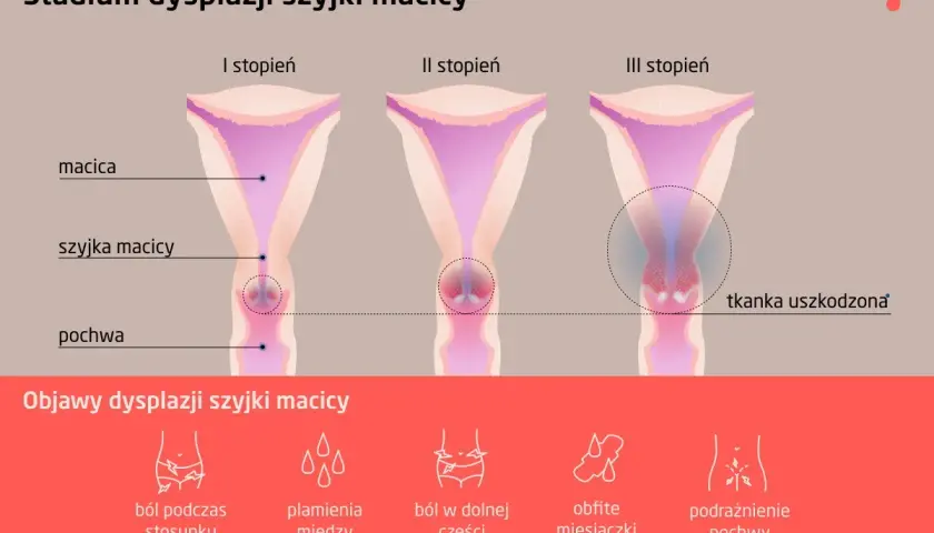 Grafika przedstawia stadia dysplazji szyjki macicy: I, II i III stopień, z zaznaczoną tkanką uszkodzoną w III stadium. Poniżej objawy: ból podczas stosunku, plamienia, ból brzucha, obfite miesiączki, podrażnienie pochwy.
