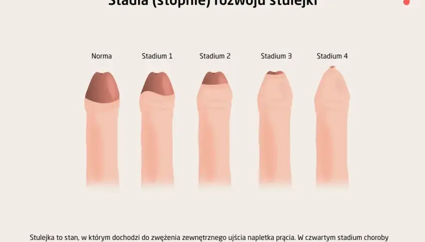 Ilustracja pokazuje stadia rozwoju stulejki u dziecka: od normy do stadium 4, gdzie widoczne są trudności z oddawaniem moczu.