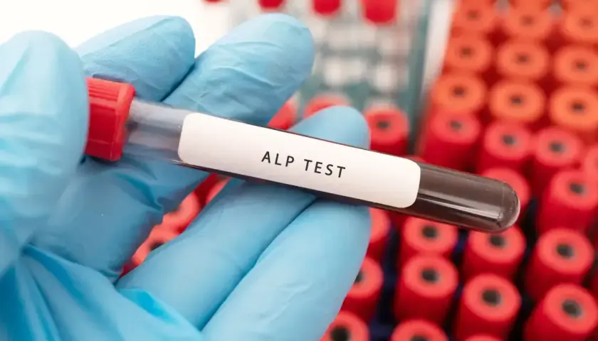 Rękawiczka w niebieskiej rękawiczce trzyma probówkę z napisem "ALP TEST". To badanie poziomu fosfatazy alkalicznej.