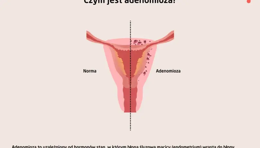 Ilustracja porównuje zdrową macicę z macicą z **adenomiozą**, gdzie tkanka endometrium wrasta w mięsień macicy.