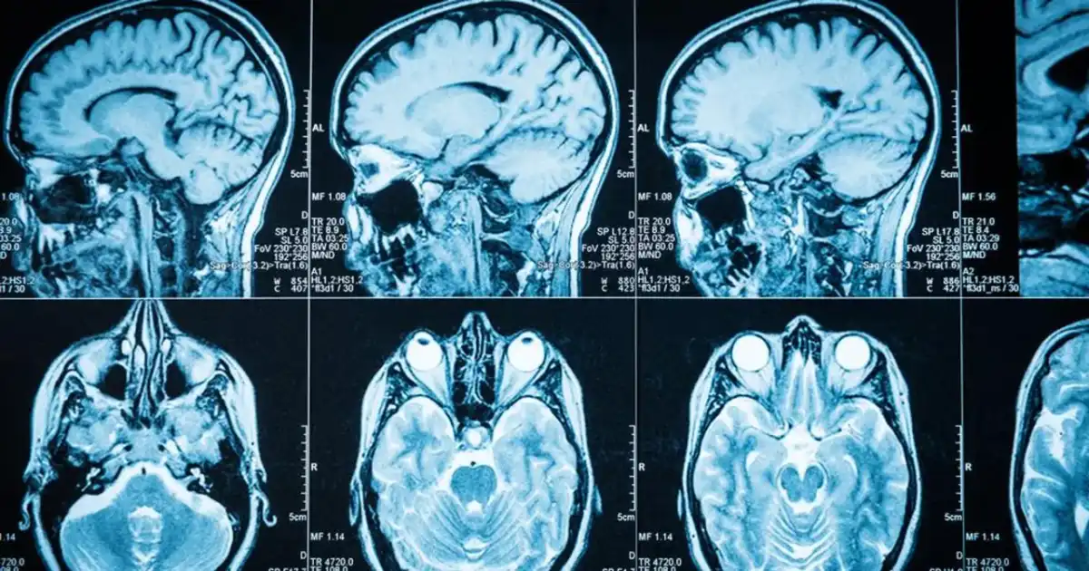 Guz mózgu - objawy, diagnostyka i leczenie