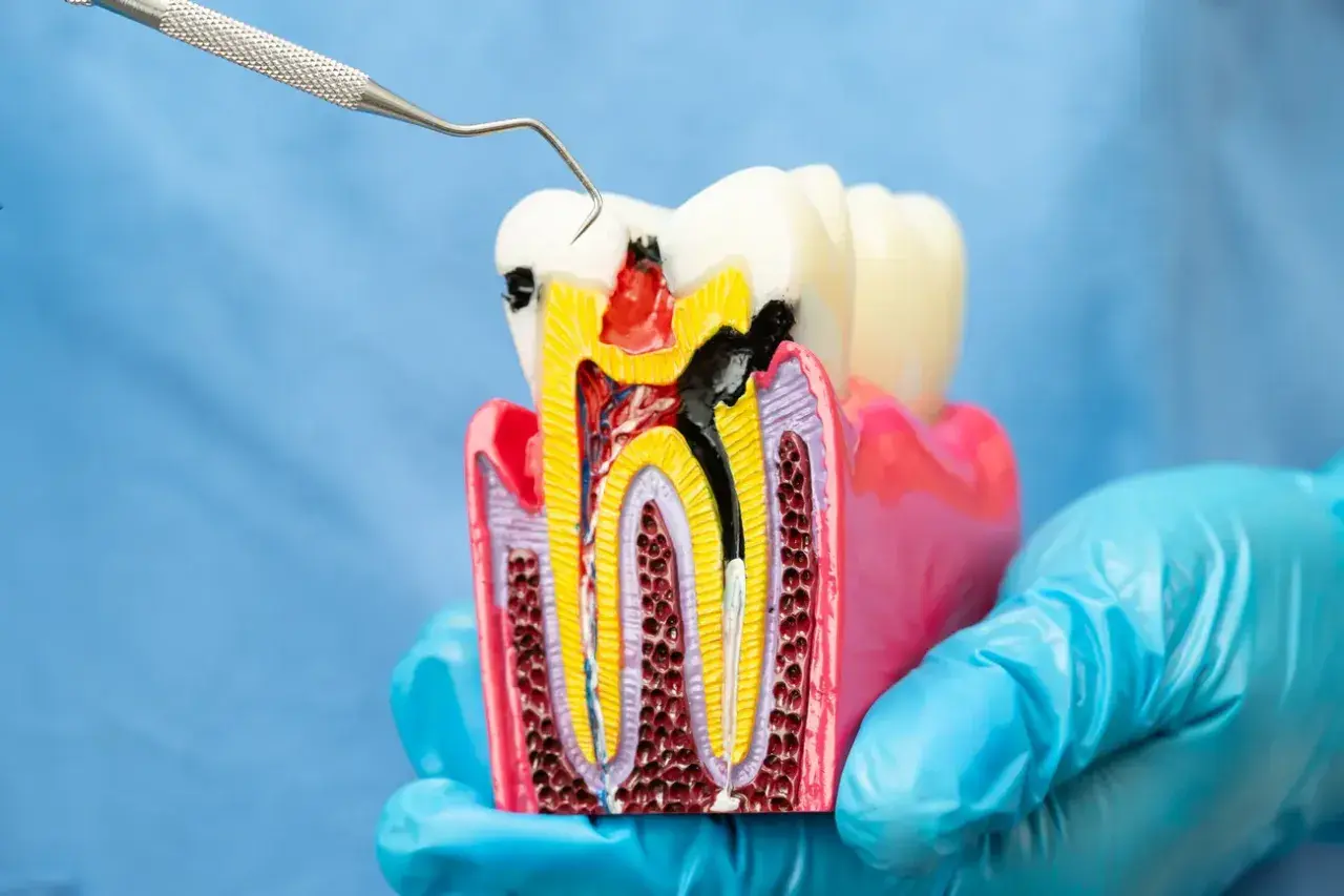 Model zęba z widocznym ubytkiem i narzędziem dentystycznym. Zastanawiasz się nad leczeniem kanałowym? Cena może być niższa niż myślisz.