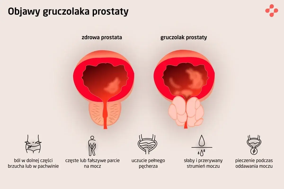Porównanie zdrowej prostaty i gruczolaka prostaty. Obrazek ilustruje objawy przerostu prostaty, takie jak ból, częste parcie na mocz i słaby strumień.