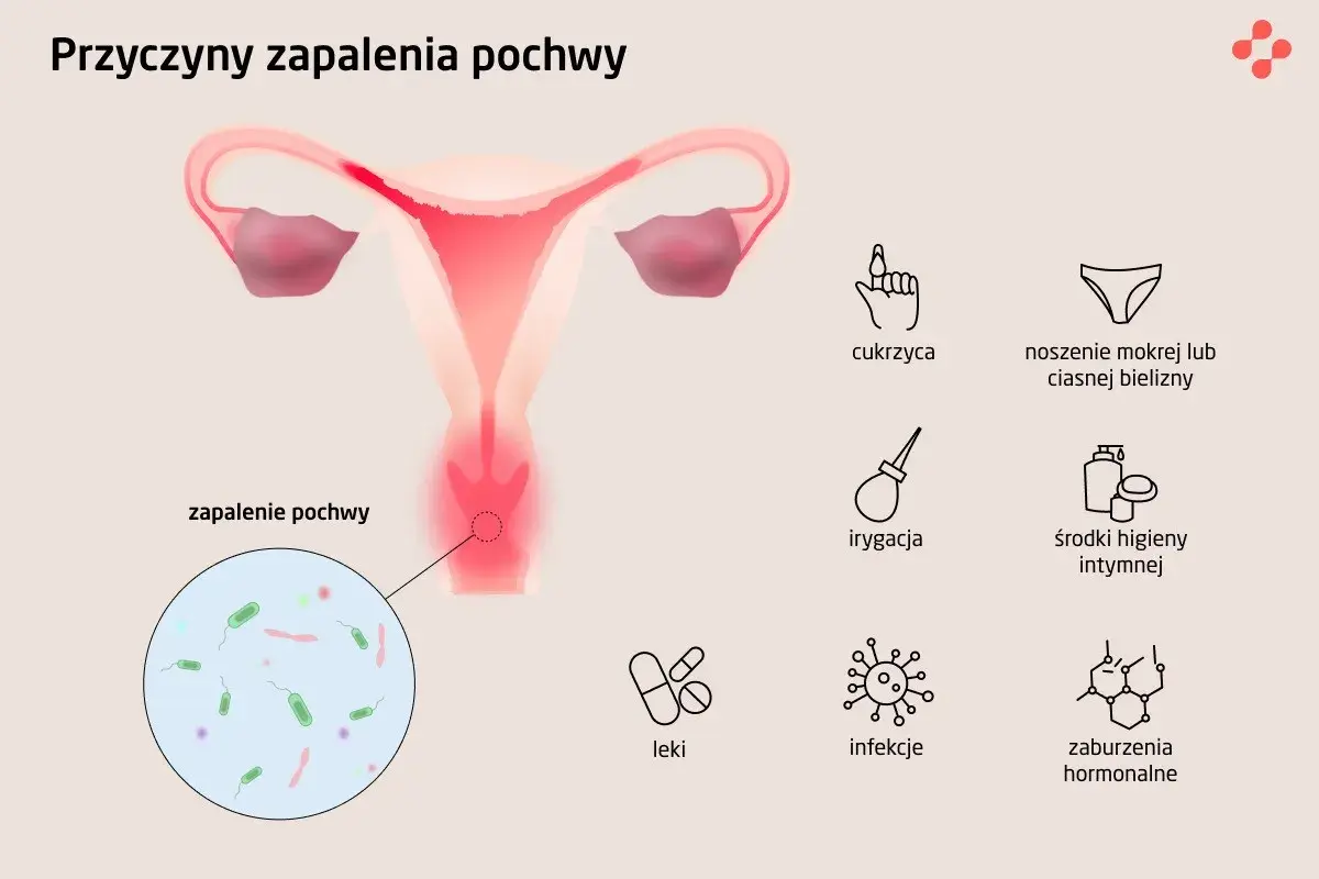 Ilustracja przedstawia przyczyny zapalenia pochwy: cukrzyca, mokra bielizna, irygacja, środki higieny intymnej, leki, infekcje, zaburzenia hormonalne.