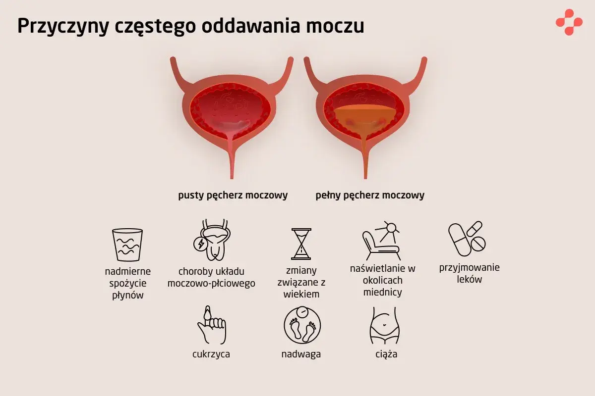 Ilustracja przedstawia pęcherz moczowy pusty i pełny, wyjaśniając przyczyny częstego oddawania moczu, w tym poliurię, np. nadmierne picie, choroby, wiek, leki, cukrzycę, nadwagę, ciążę.