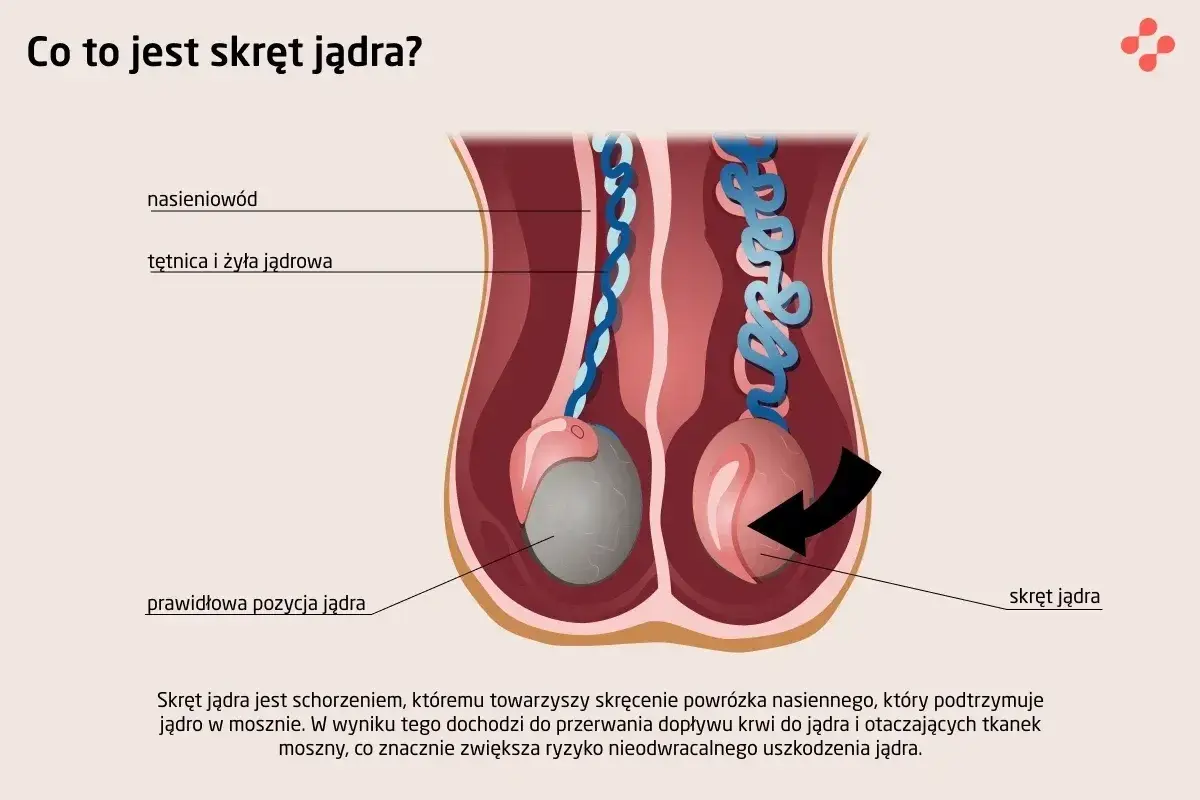 Ilustracja pokazuje prawidłową pozycję jądra i jego skręt. Skręt jądra to stan, gdy powrózek nasienny się skręca, blokując dopływ krwi.