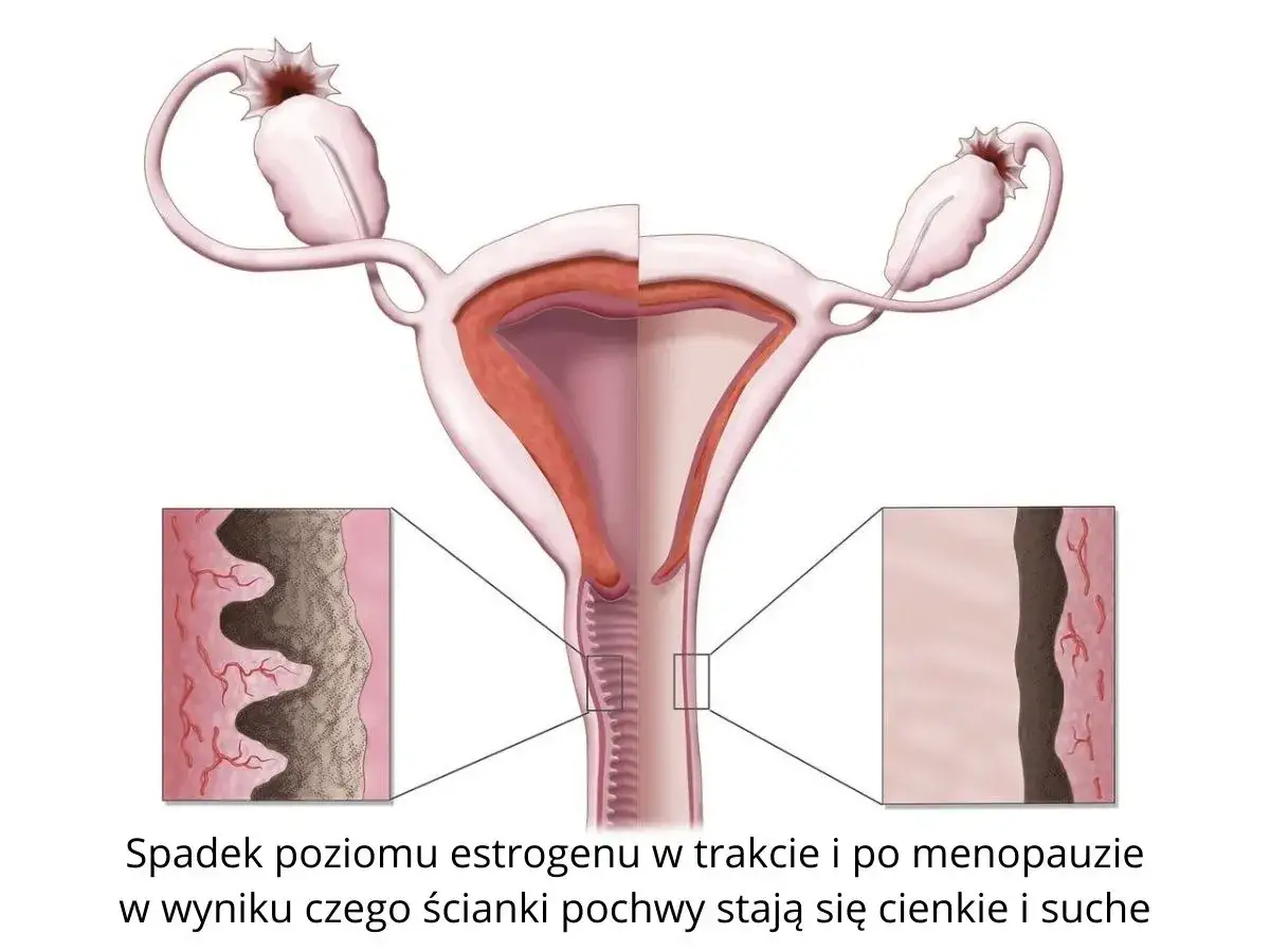 Ilustracja pokazuje zmiany w pochwie podczas menopauzy, prowadzące do suchości pochwy. Ścianki stają się cieńsze i mniej nawilżone.
